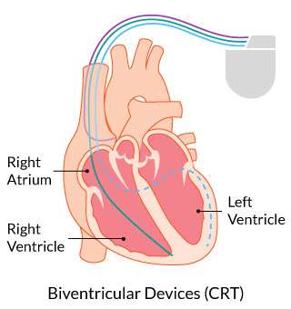 Biventricular devices (CRT)