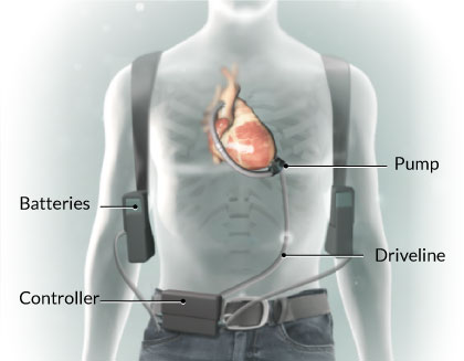 Left Ventricular Assist Devices (LVADs) components