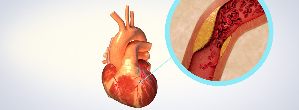 What Causes Heart Failure?